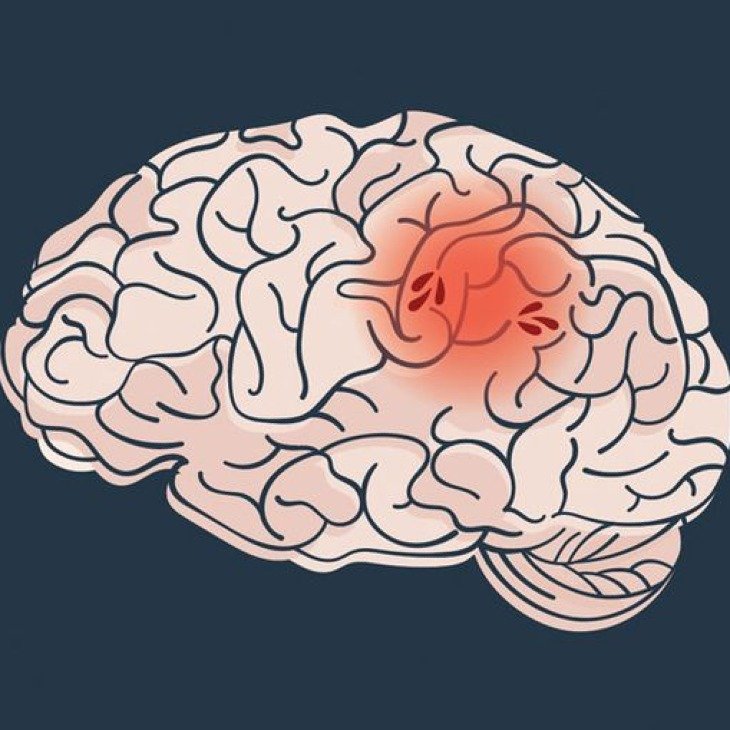 Gambar: Cara Mencegah Stroke Sejak Dini: Gaya Hidup Sehat yang Bisa Kamu Mulai Hari Ini