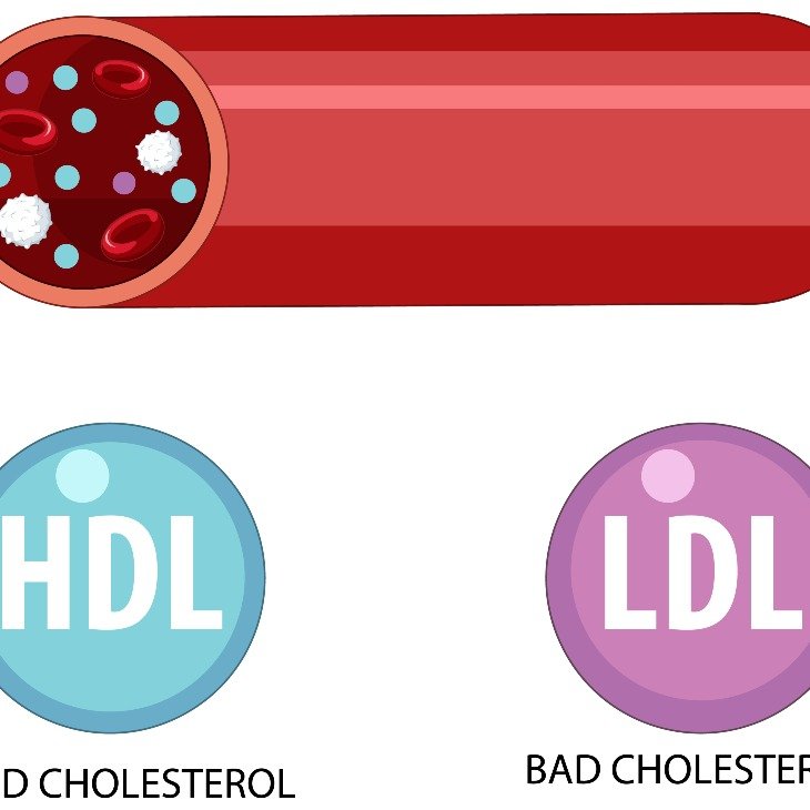 Gambar: Gejala Kolesterol Tinggi yang Perlu Diwaspadai